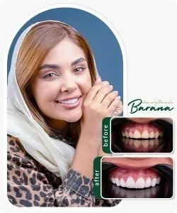 انواع و معرفی بهترین نوع کامپوزیت دندان