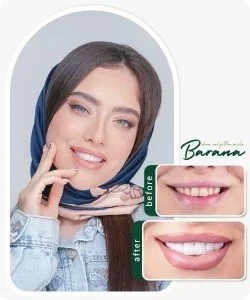 انواع و معرفی بهترین نوع کامپوزیت دندان