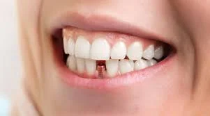 چه مدت پس از ایمپلنت دندان نباید غذا خورد؟