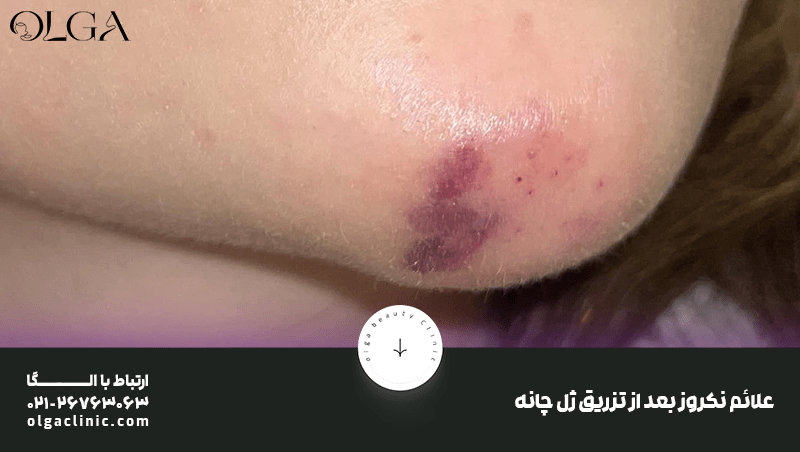 درمان | زیبایی نکروز چانه بعد از تزریق ژل چیست و چطور درمان می شود؟
