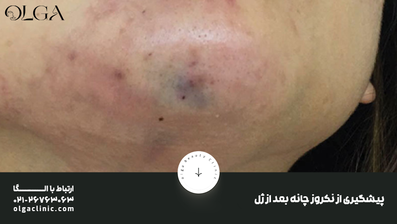 درمان | زیبایی پیشگیری از نکروز چانه بعد از فیلر