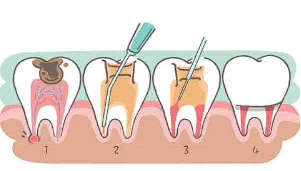 درمان | دندانپزشکی آیا دندان شیری عصب دارد؟