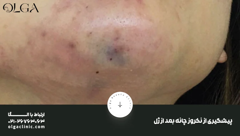 درمان | زیبایی نکروز چانه بعد از تزریق ژل چیست و چطور درمان می شود؟