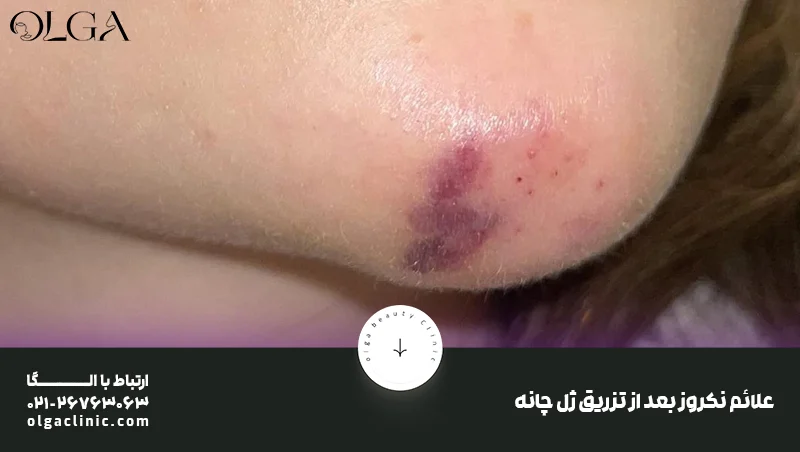 درمان | زیبایی نکروز چانه بعد از تزریق ژل چیست و چطور درمان می شود؟